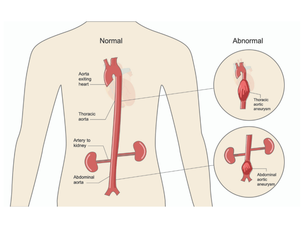 Vascular Education My Vascular Health 5818