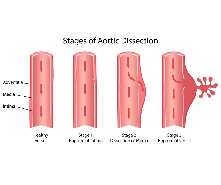Stages of Aortic Dissection