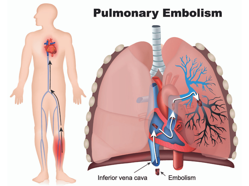 Pulmonary Embolism